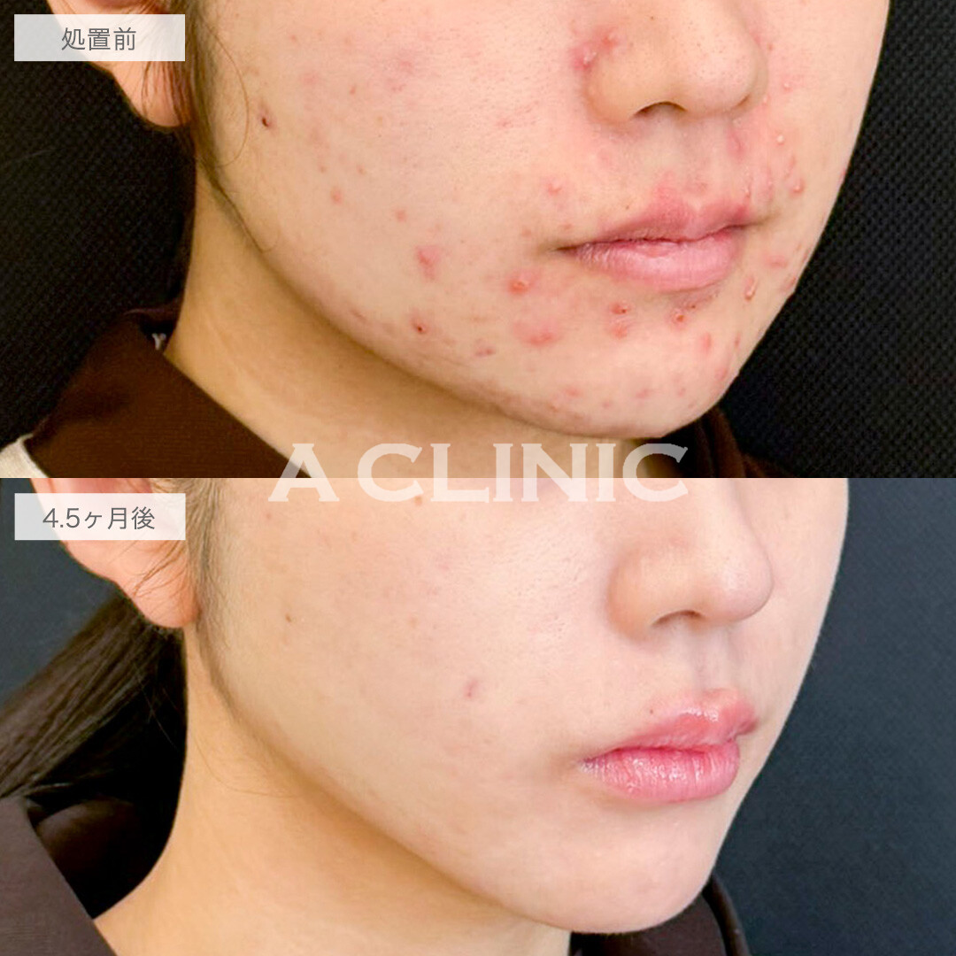 1day小顔脂肪吸引とイソトレチノインでお悩みを一度に解決！処置前と4ヶ月半後の症例です(10代女性)