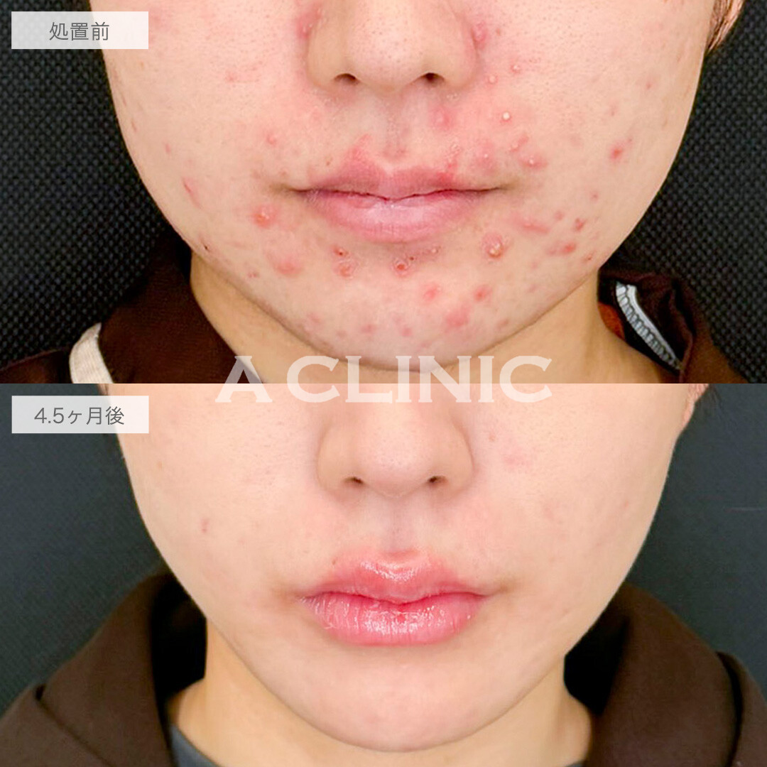 1day小顔脂肪吸引とイソトレチノインでお悩みを一度に解決！処置前と4ヶ月半後の症例です(10代女性)