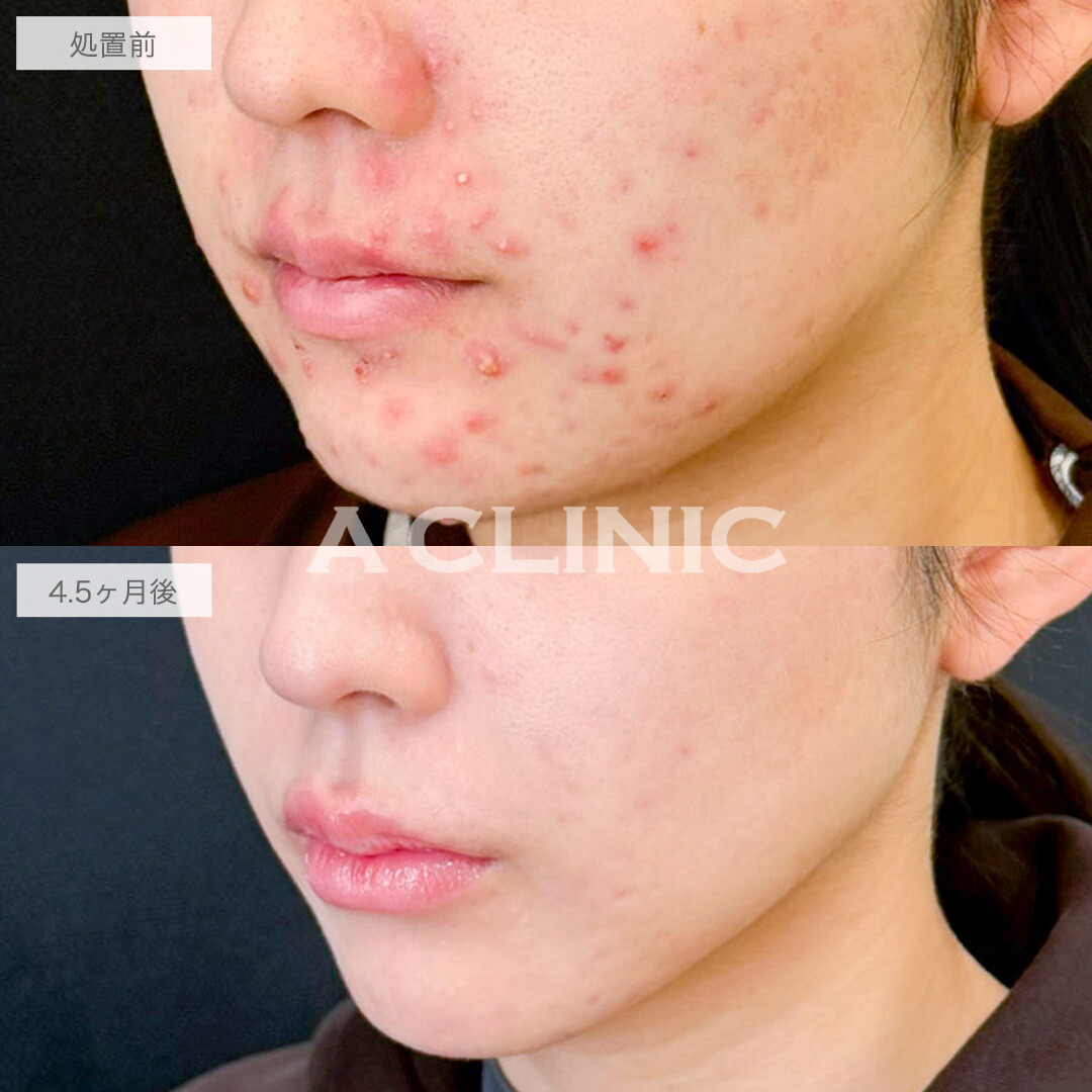 1day小顔脂肪吸引とイソトレチノインでお悩みを一度に解決！処置前と4ヶ月半後の症例です(10代女性)