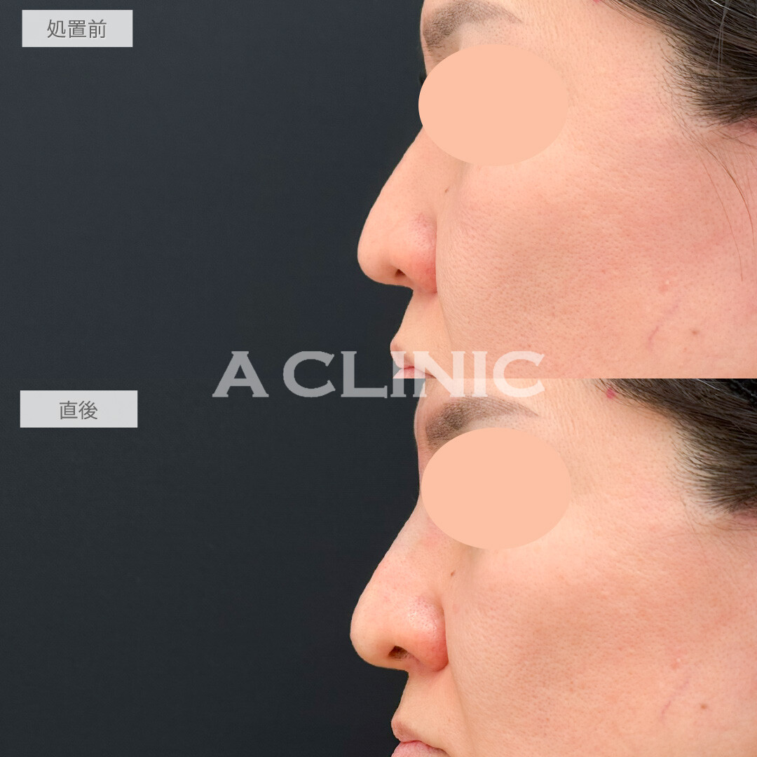 ジャスミンノーズで鼻全体を高くしキリッとした美人顔に！処置前と直後の症例です(40代女性)