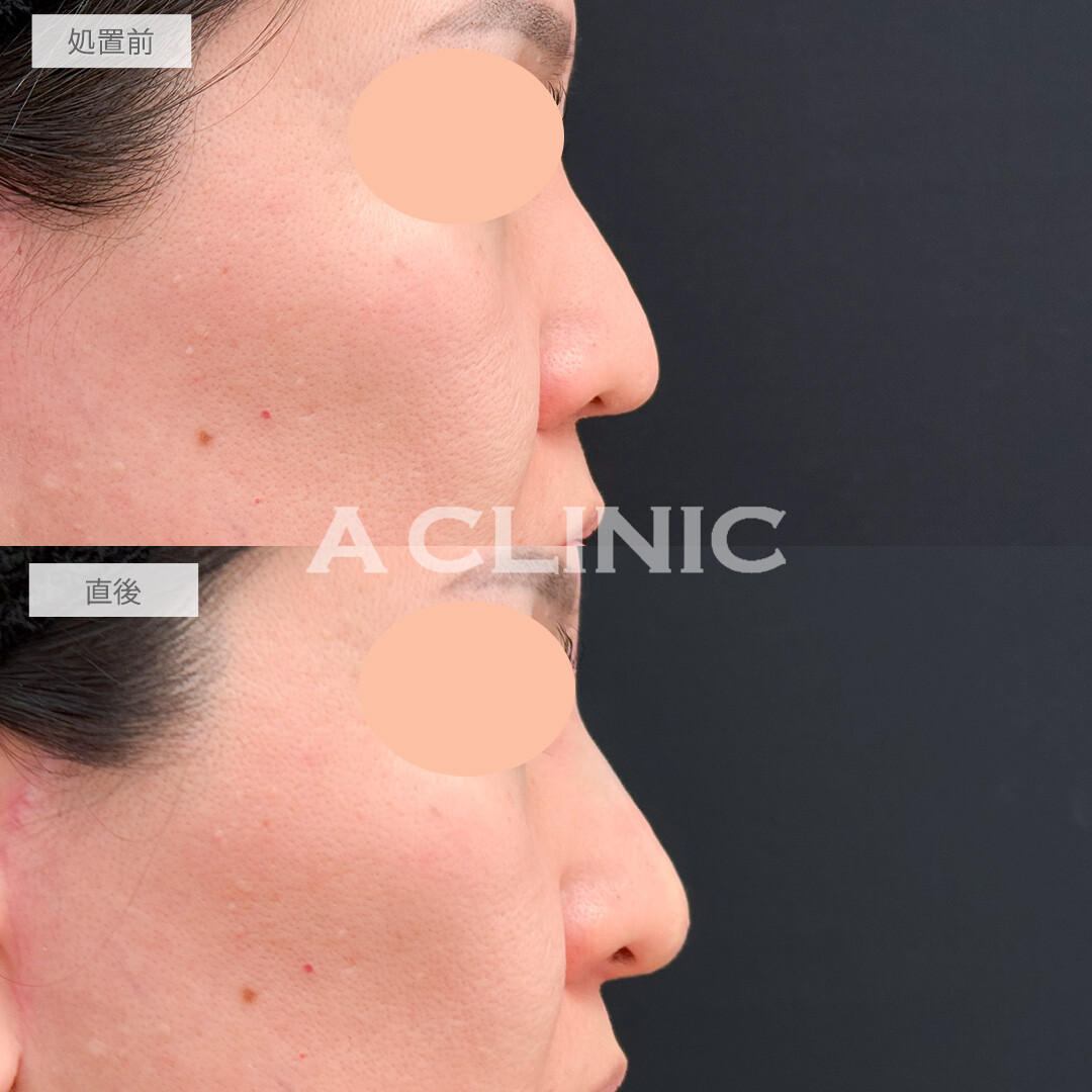 ジャスミンノーズで鼻全体を高くしキリッとした美人顔に！処置前と直後の症例です(40代女性)