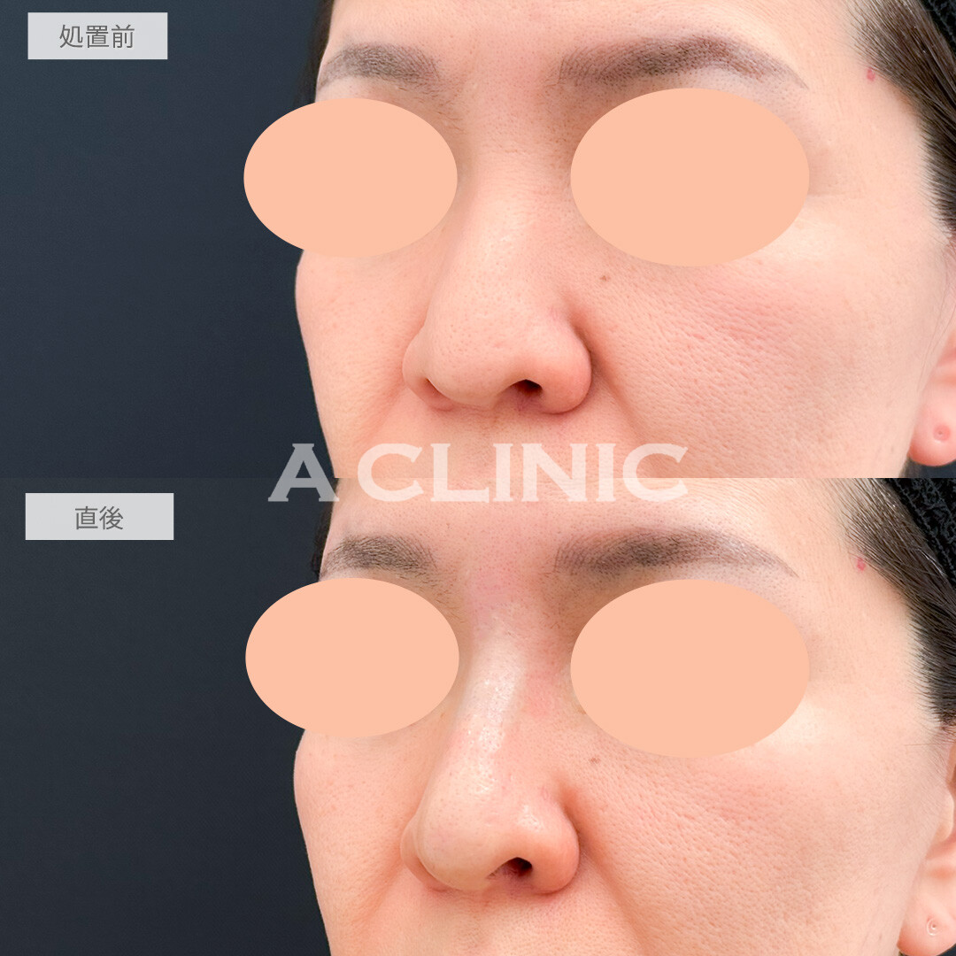ジャスミンノーズで鼻全体を高くしキリッとした美人顔に！処置前と直後の症例です(40代女性)