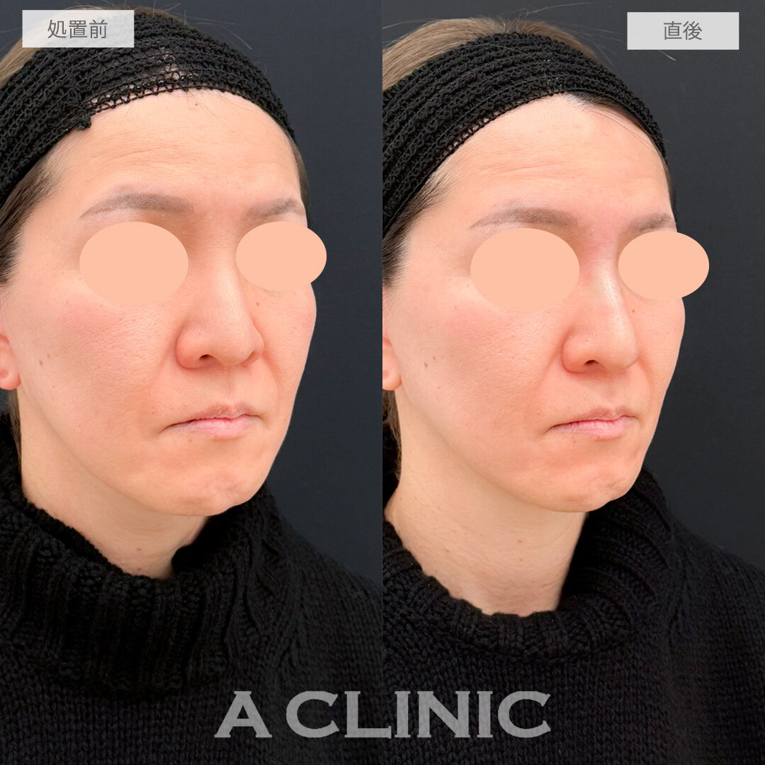 ジャスミンノーズで鼻全体を高くしキリッとした美人顔に！処置前と直後の症例です(40代女性)