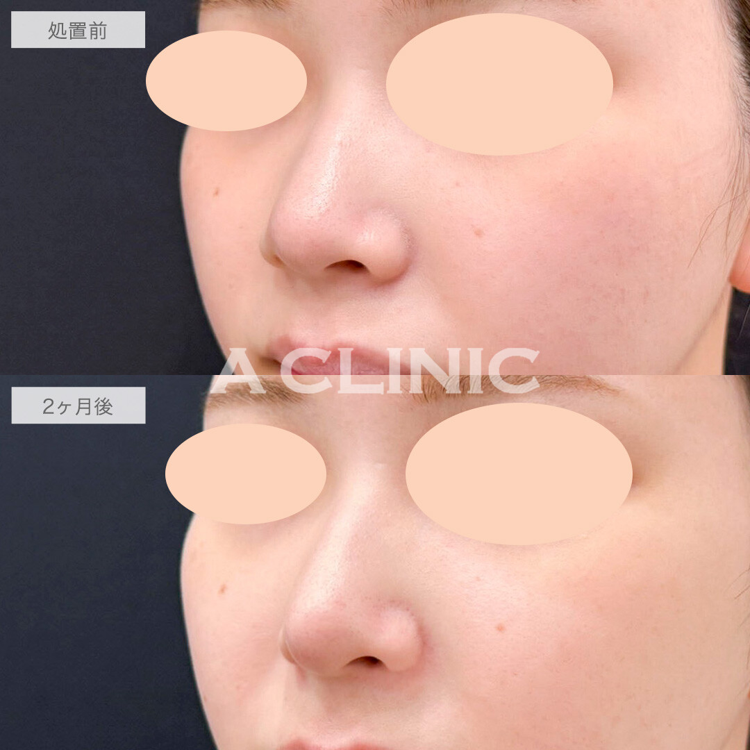 鼻尖形成(耳介軟骨・耳珠軟骨移植)で自然にツンとした鼻先に！処置前と2ヶ月後の症例です(20代女性)