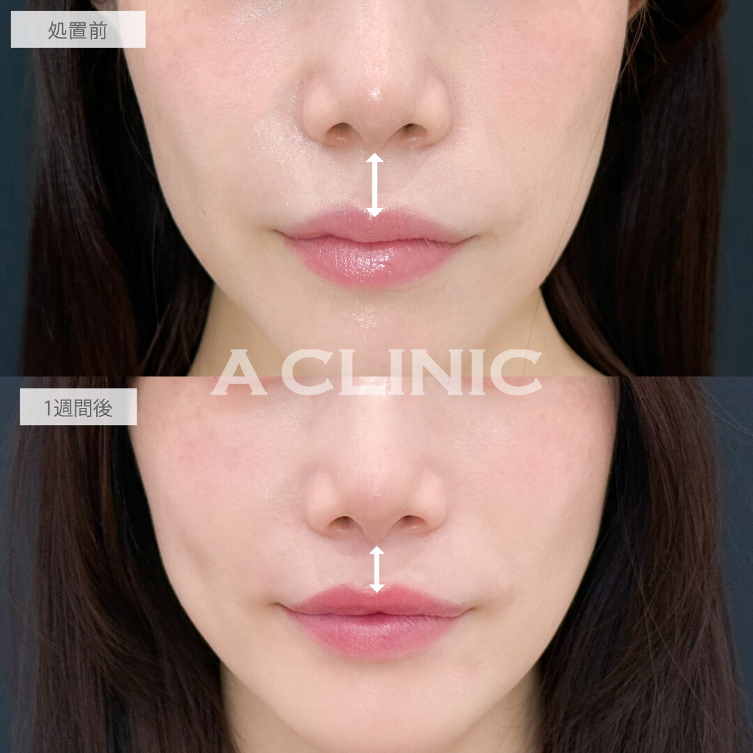 切らない人中短縮(Cカール形成術)で切らずに人中が短くなって美人見え！こちら処置前と1週間後の症例です(30代女性)