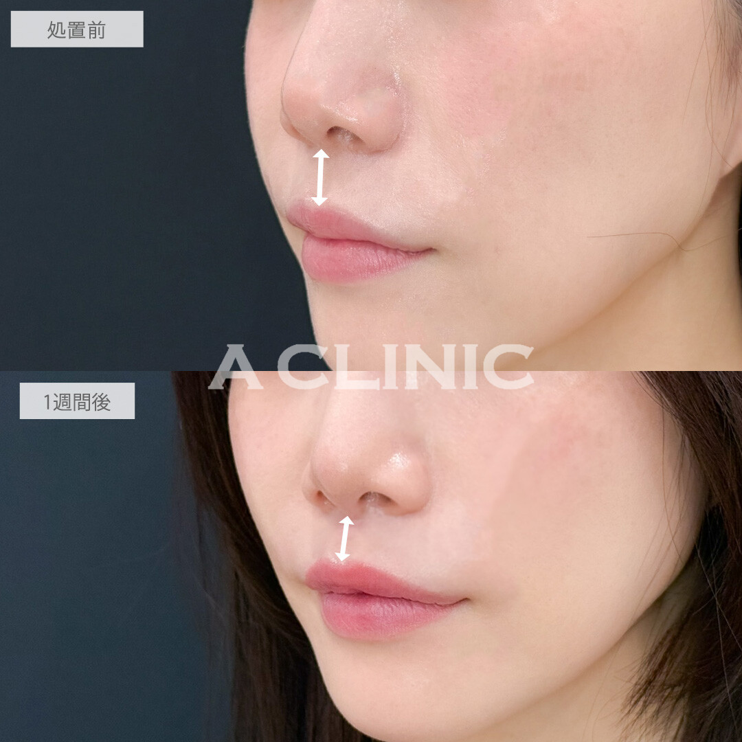 切らない人中短縮(Cカール形成術)で切らずに人中が短くなって美人見え！こちら処置前と1週間後の症例です(30代女性)