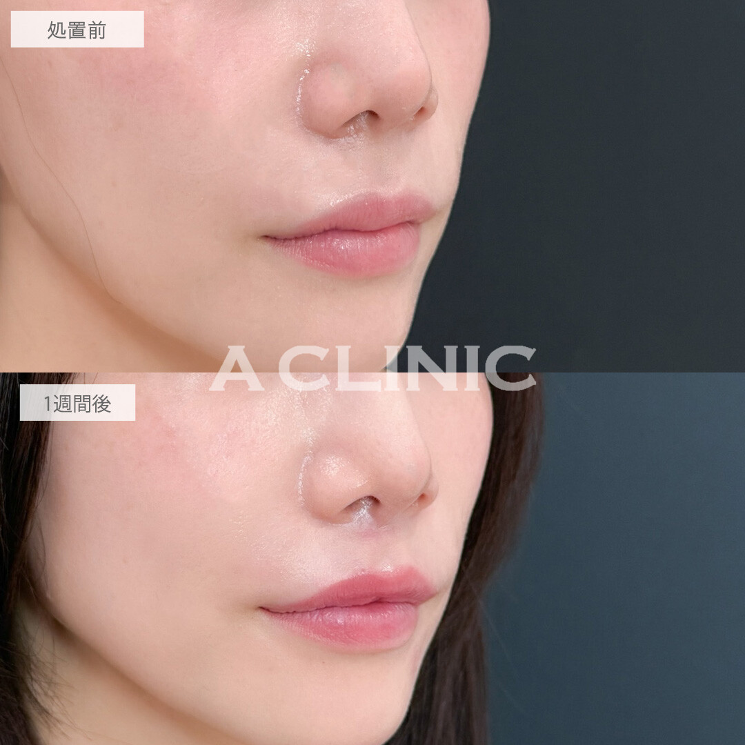 切らない人中短縮(Cカール形成術)で切らずに人中が短くなって美人見え！こちら処置前と1週間後の症例です(30代女性)