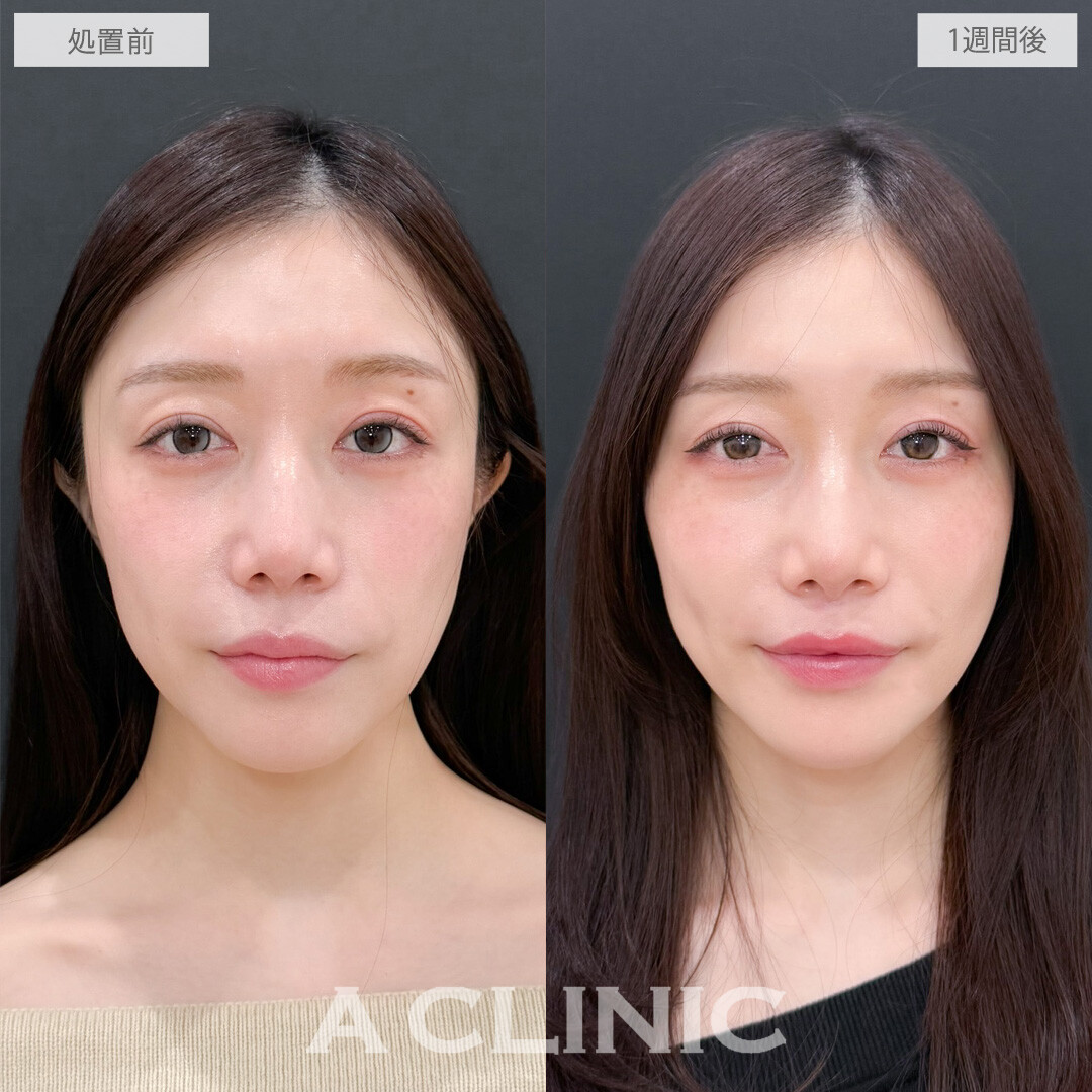 切らない人中短縮(Cカール形成術)で切らずに人中が短くなって美人見え！こちら処置前と1週間後の症例です(30代女性)