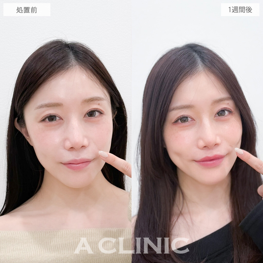 切らない人中短縮(Cカール形成術)で切らずに人中が短くなって美人見え！こちら処置前と1週間後の症例です(30代女性)