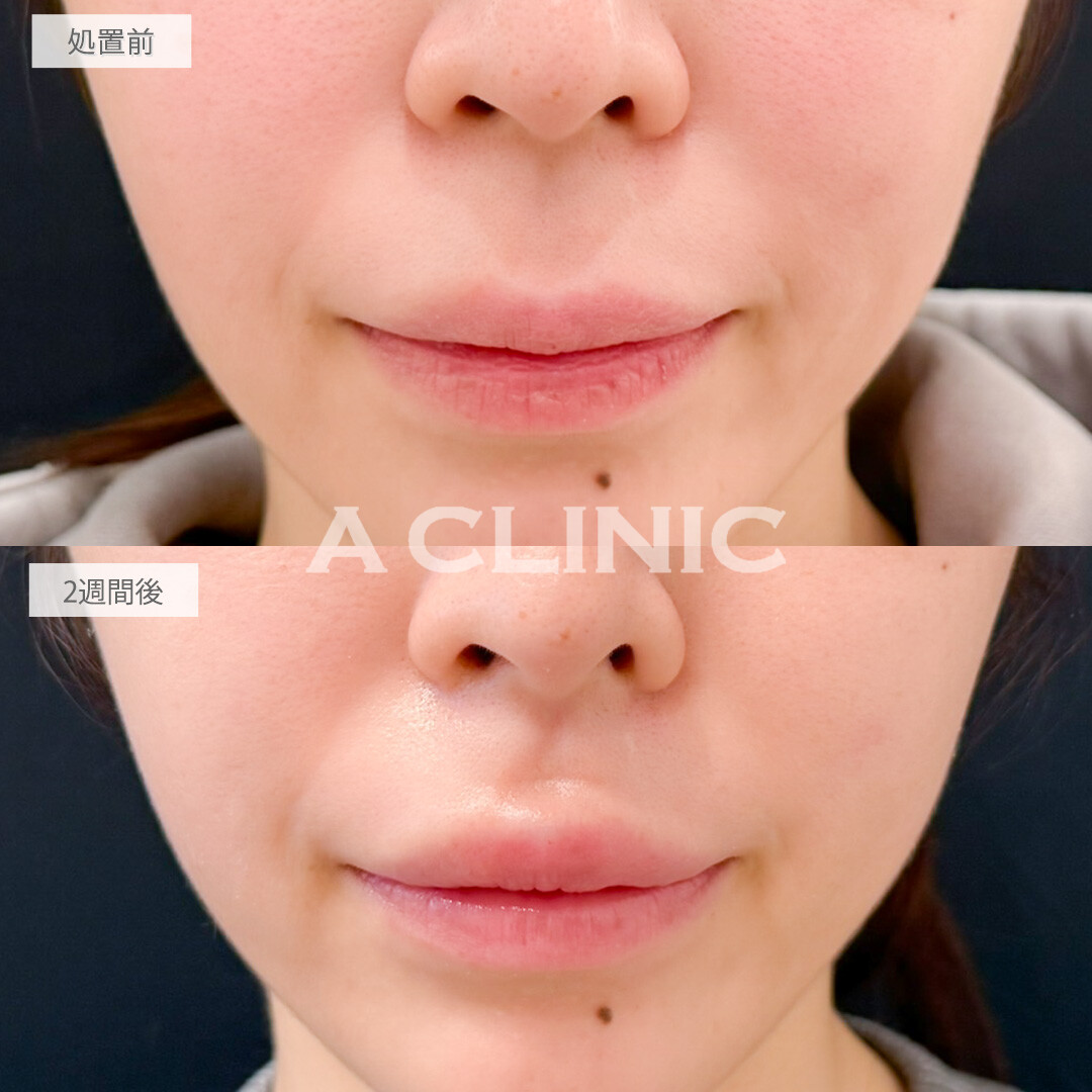 切らない人中短縮(Cカール形成術)とリップヒアルロン酸注入で上向きの可愛らしい口元になりました！処置前と2週間後の症例です(30代女性)