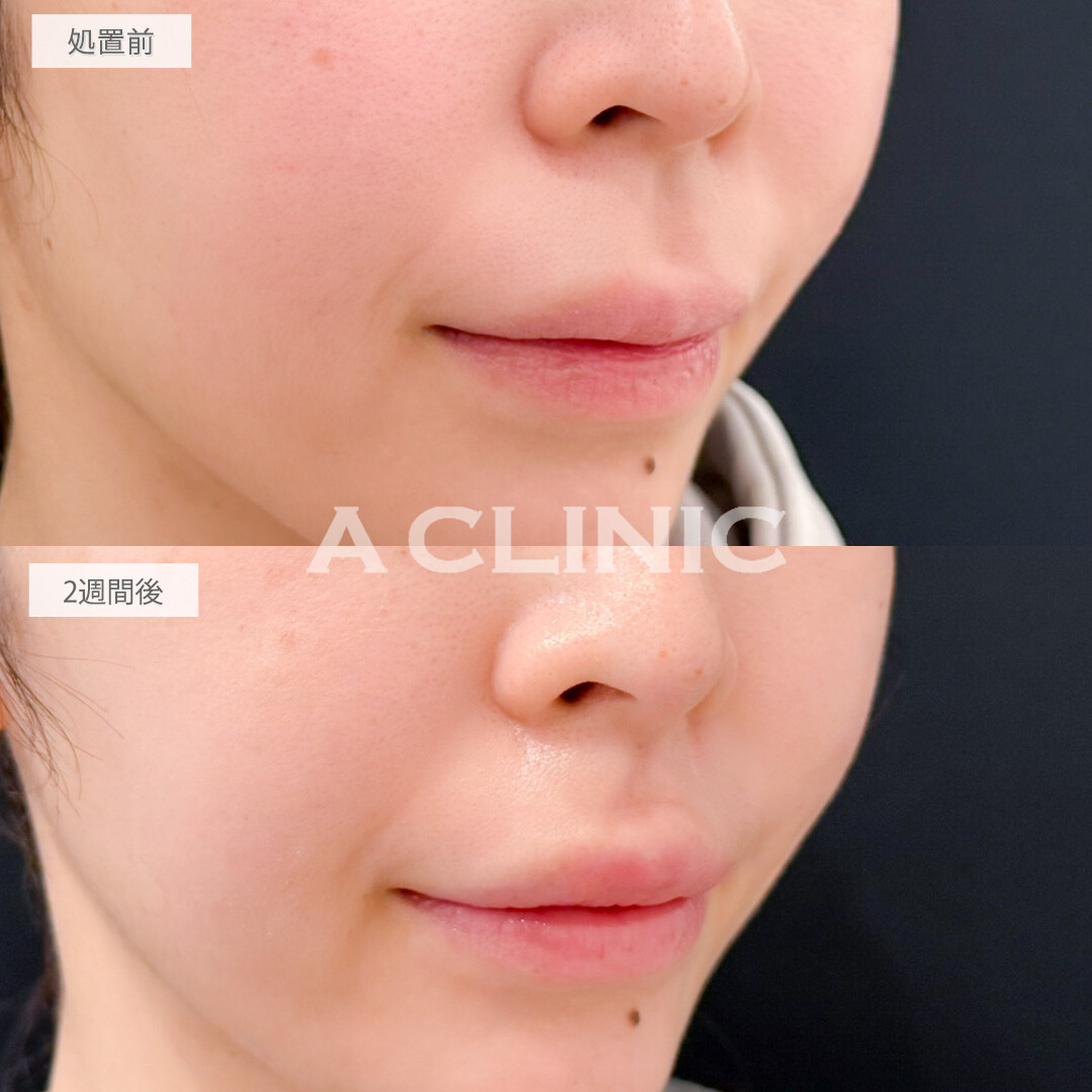 切らない人中短縮(Cカール形成術)とリップヒアルロン酸注入で上向きの可愛らしい口元になりました！処置前と2週間後の症例です(30代女性)
