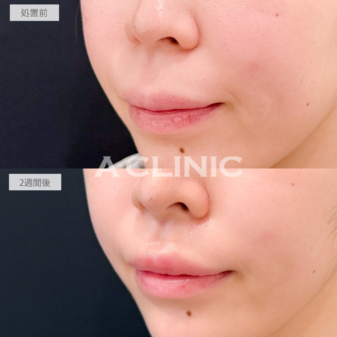 切らない人中短縮(Cカール形成術)とリップヒアルロン酸注入で上向きの可愛らしい口元になりました！処置前と2週間後の症例です(30代女性)