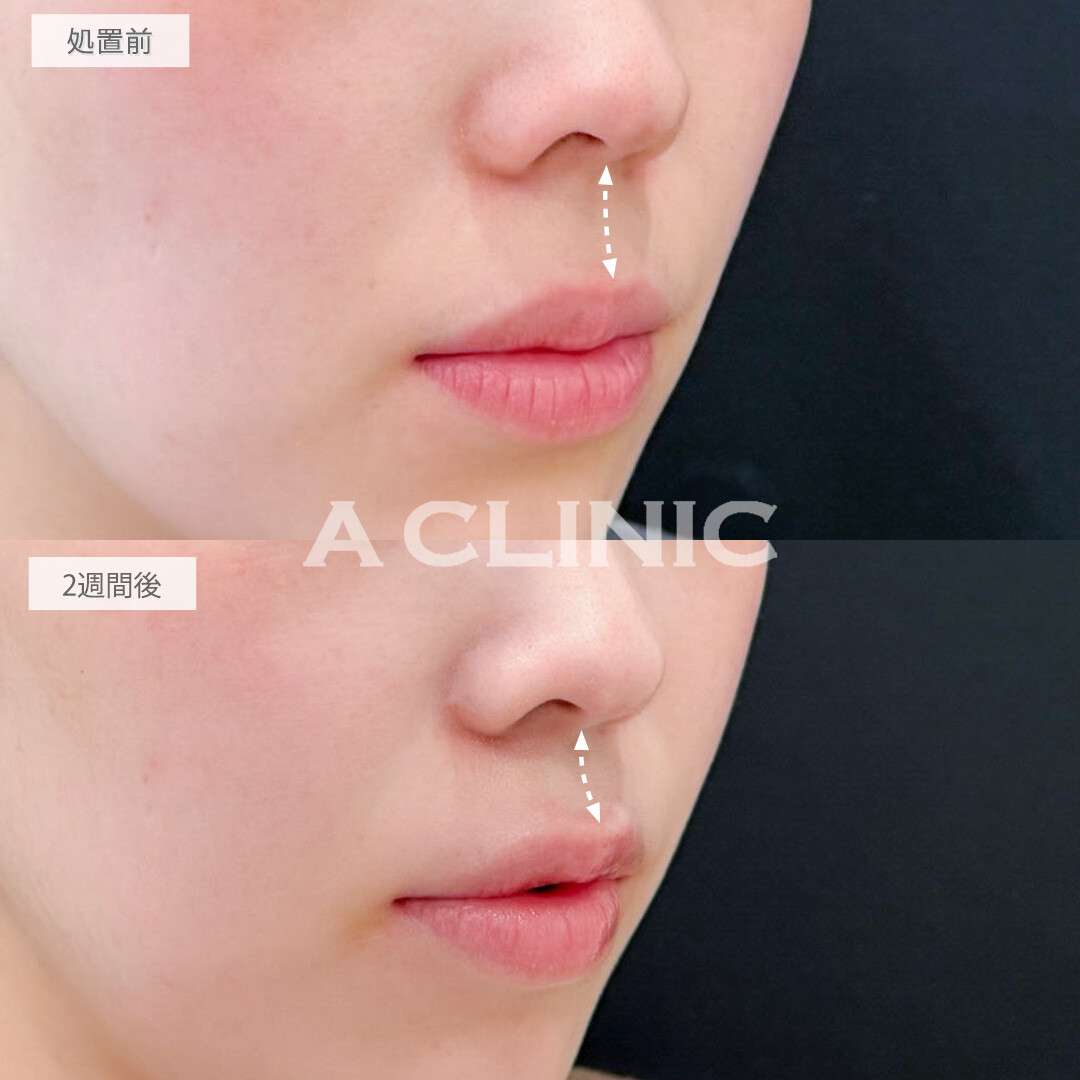 切らない人中短縮(Cカール形成術)とリップヒアルロン酸注入で口元アップデートするだけで一気に垢抜け！処置前と2週間後の症例です(20代女性)