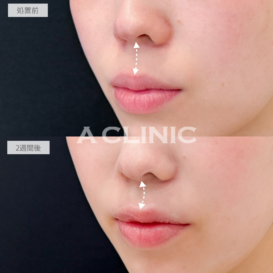 切らない人中短縮(Cカール形成術)とリップヒアルロン酸注入で口元アップデートするだけで一気に垢抜け！処置前と2週間後の症例です(20代女性)