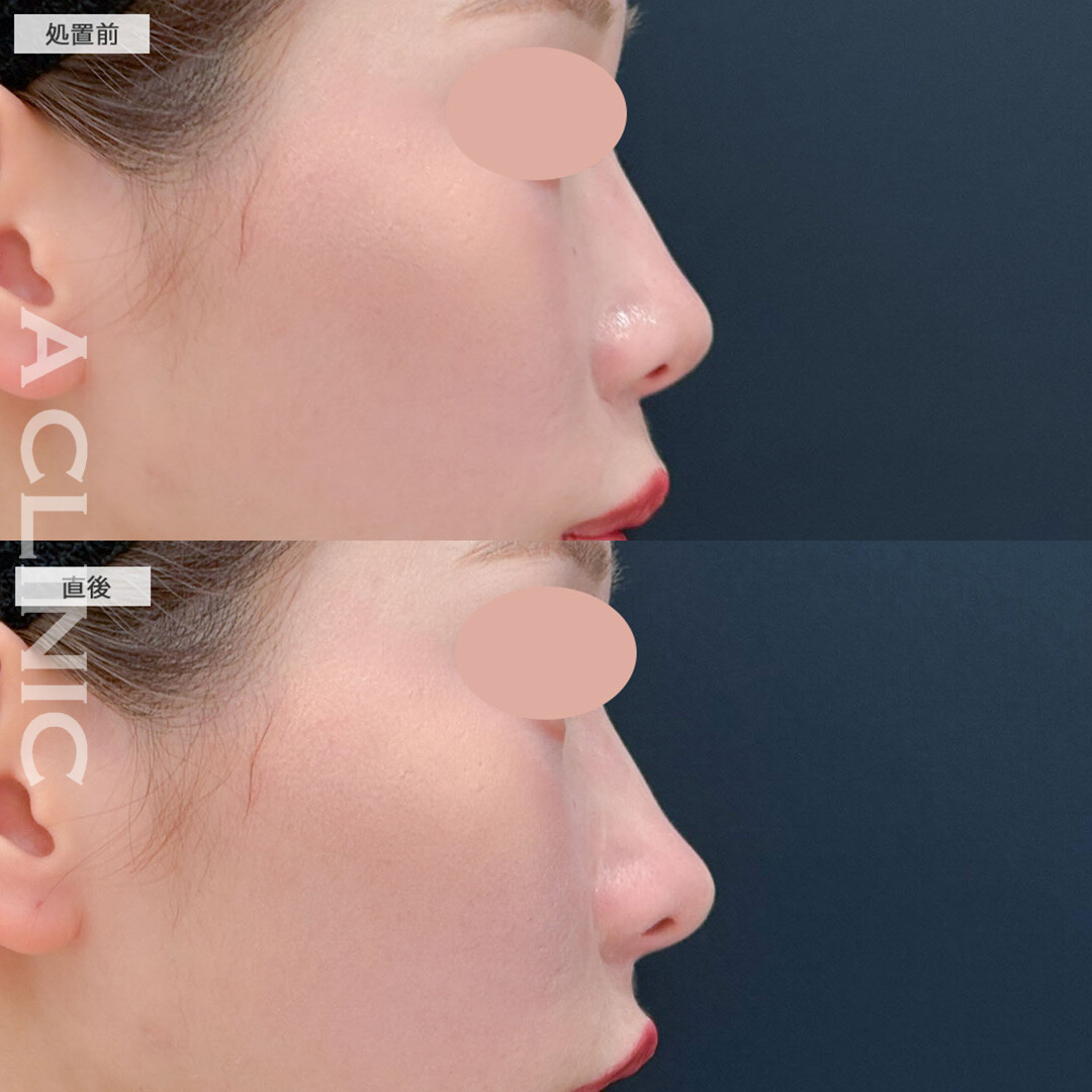 コリアンノーズで自然と鼻先が高くなりました！こちら処置前と直後の症例です(20代女性)