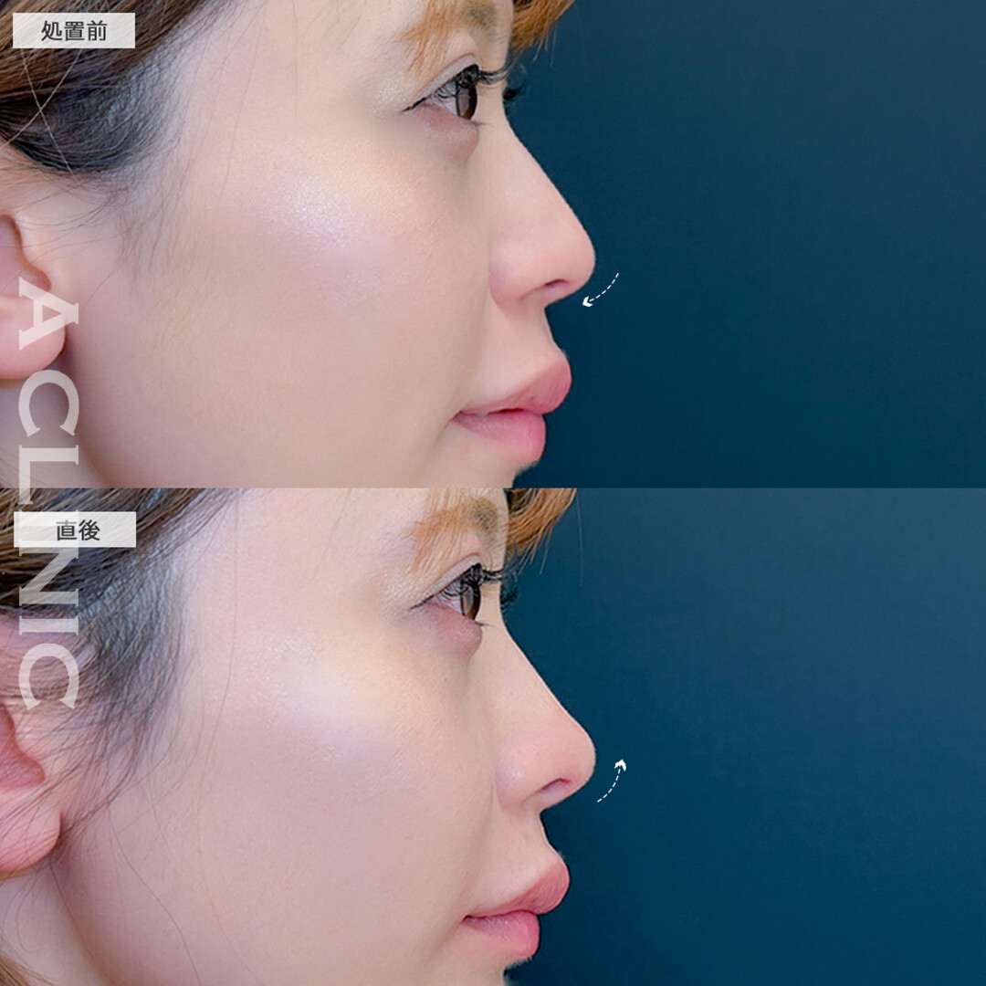 コリアンノーズで鼻先にヒアルロン酸を注入し綺麗なアップノーズになりました！こちら処置前と直後の症例です(30代女性)