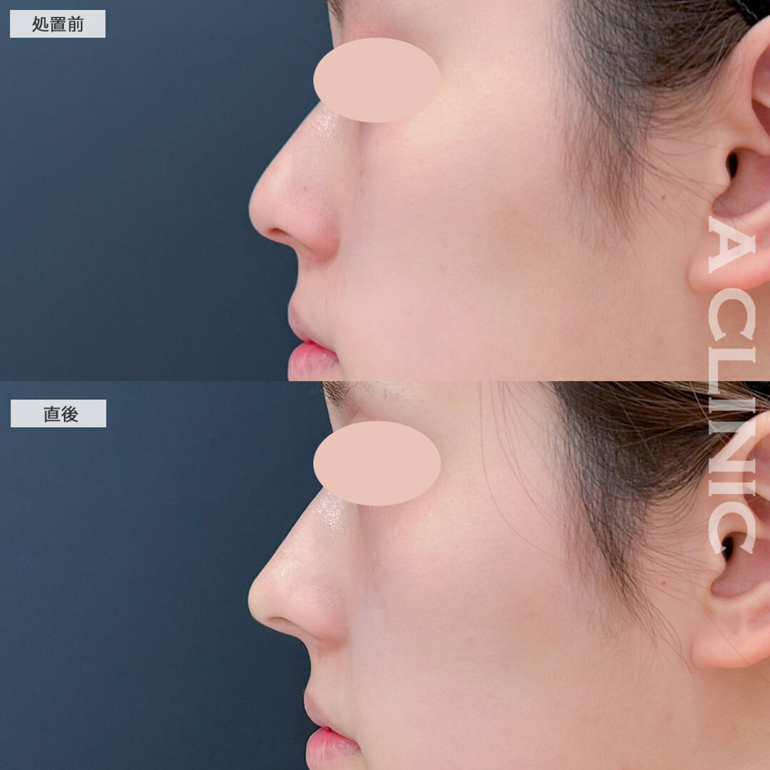コリアンノーズで韓国美人のようなアップノーズになりました！こちら処置前と直後の症例です(20代女性)