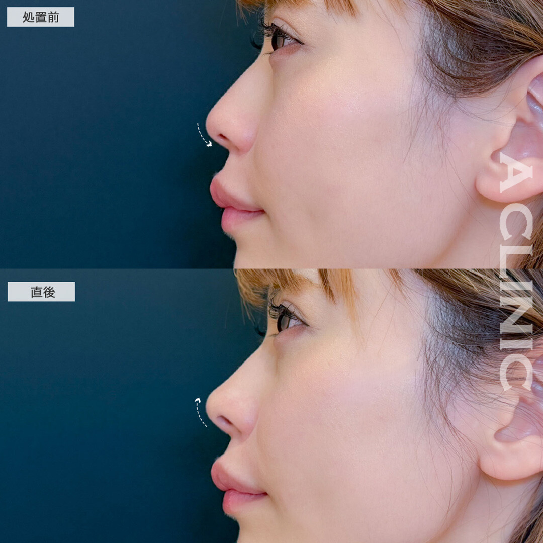 コリアンノーズで鼻先にヒアルロン酸を注入し綺麗なアップノーズになりました！こちら処置前と直後の症例です(30代女性)