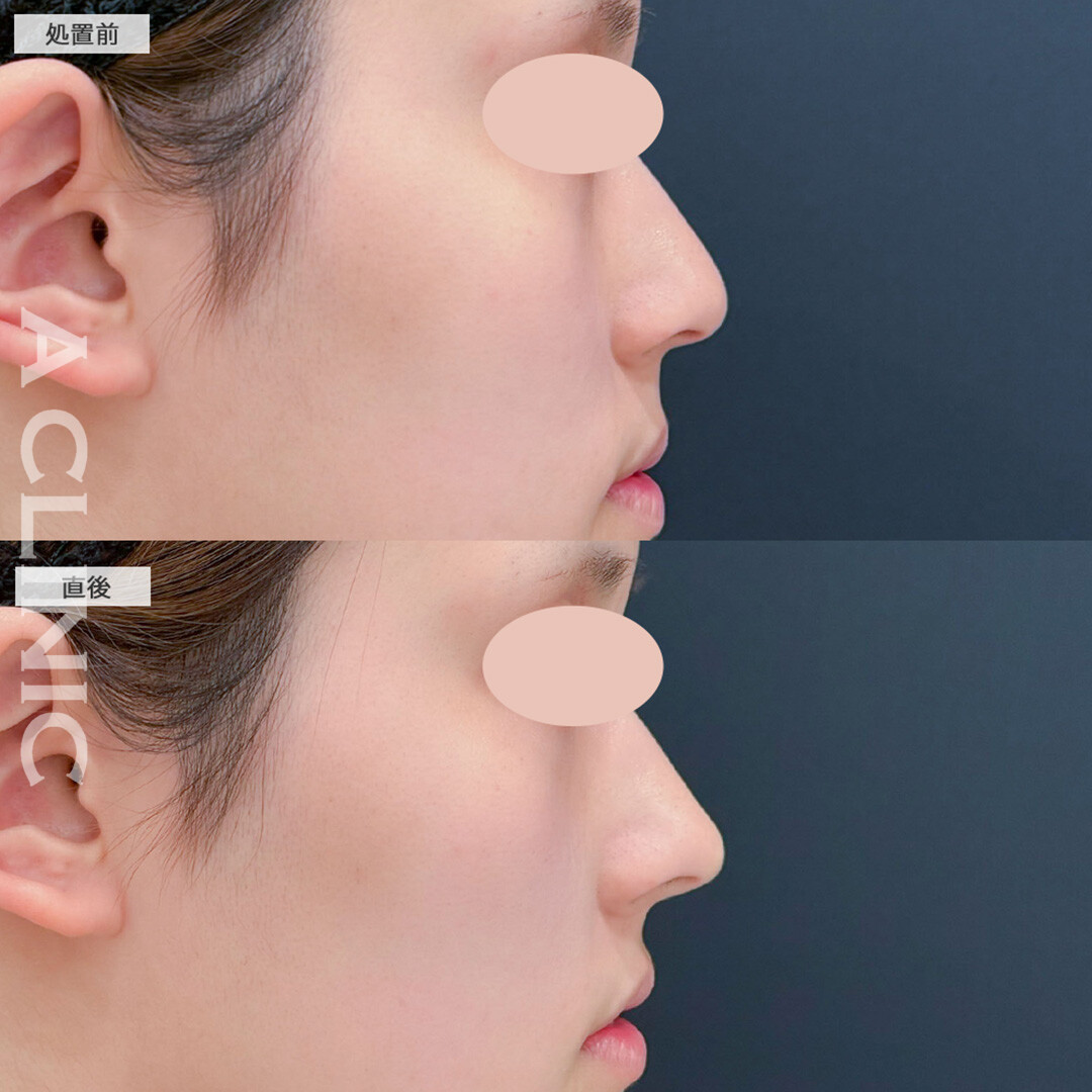 コリアンノーズで韓国美人のようなアップノーズになりました！こちら処置前と直後の症例です(20代女性)