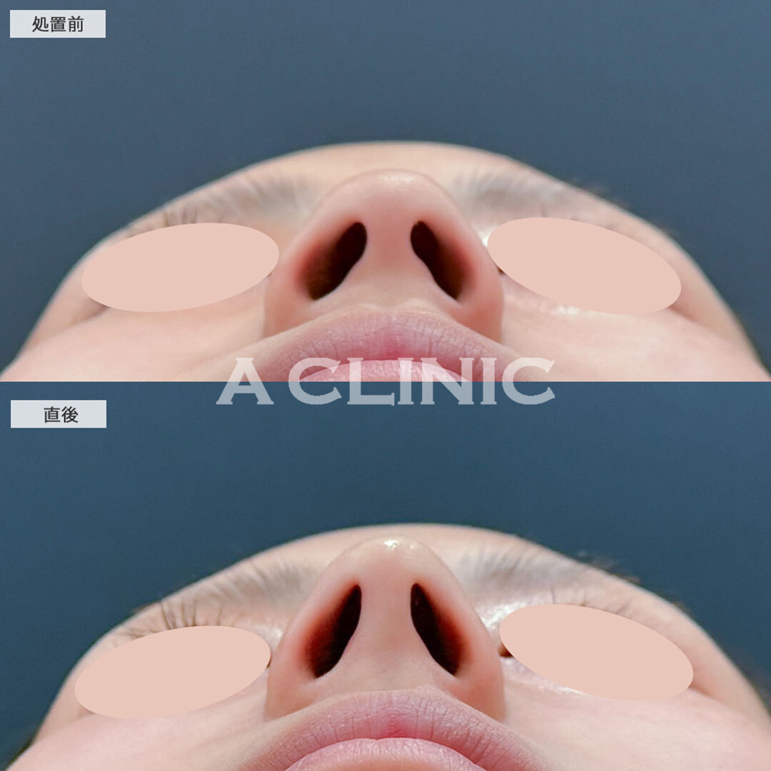 コリアンノーズで韓国美人のようなアップノーズになりました！こちら処置前と直後の症例です(20代女性)