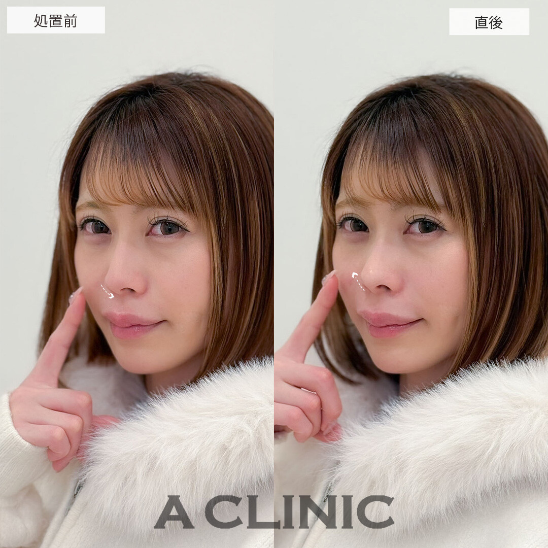 コリアンノーズで鼻先にヒアルロン酸を注入し綺麗なアップノーズになりました！こちら処置前と直後の症例です(30代女性)