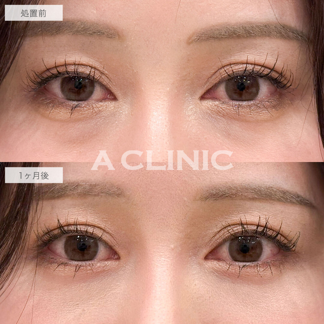 目の下のクマ取りで疲れ目解消し明るい目元へ！こちら処置前と1ヶ月後の症例です(30代女性)