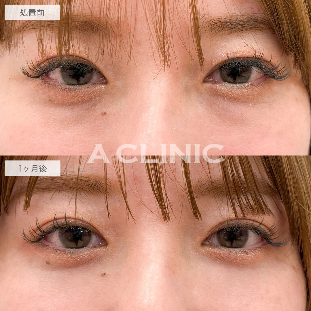 目の下のクマ取りで余分な脂肪を取り除きスッキリとした目元へ！こちら処置前と1ヶ月後の症例です(30代女性)