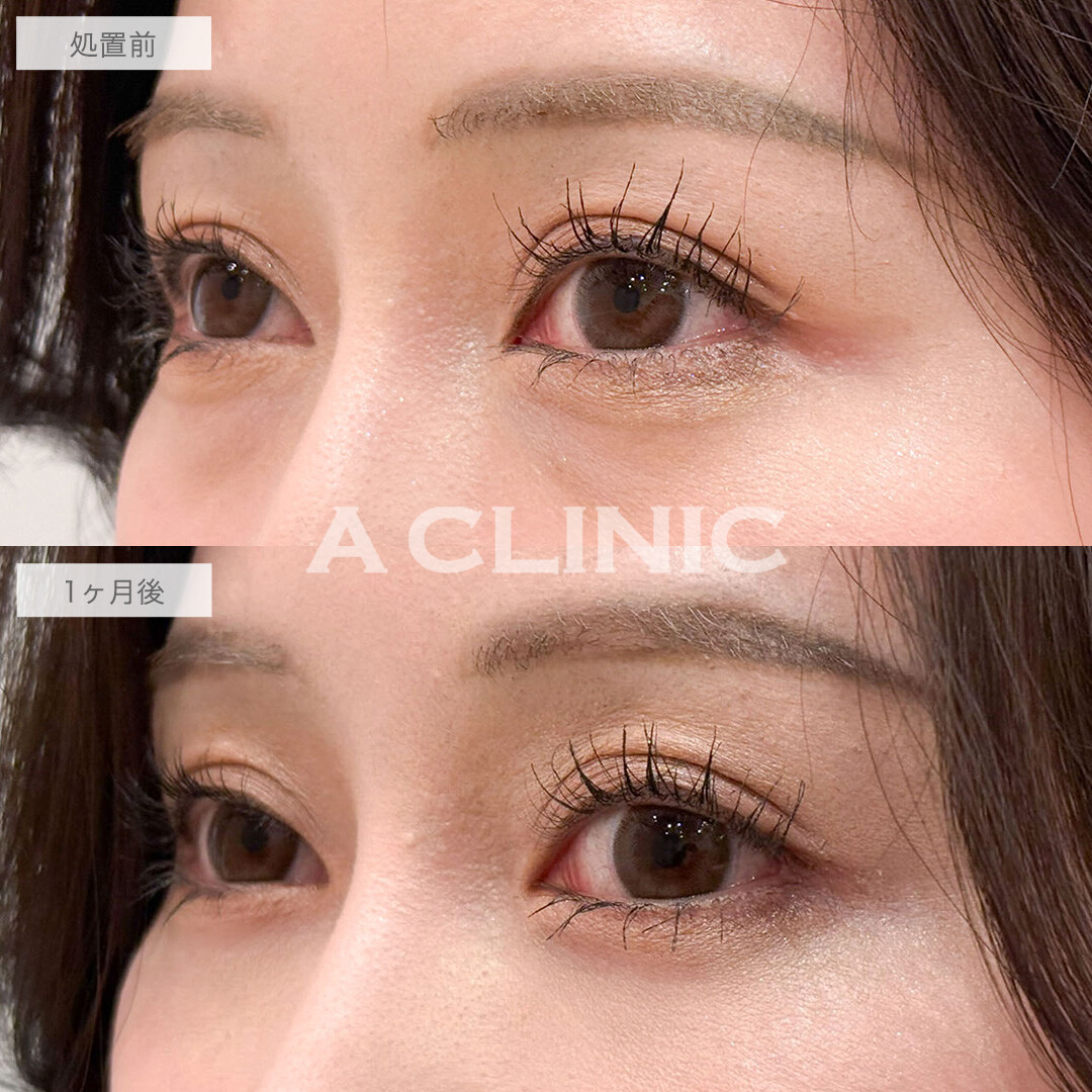 目の下のクマ取りで疲れ目解消し明るい目元へ！こちら処置前と1ヶ月後の症例です(30代女性)