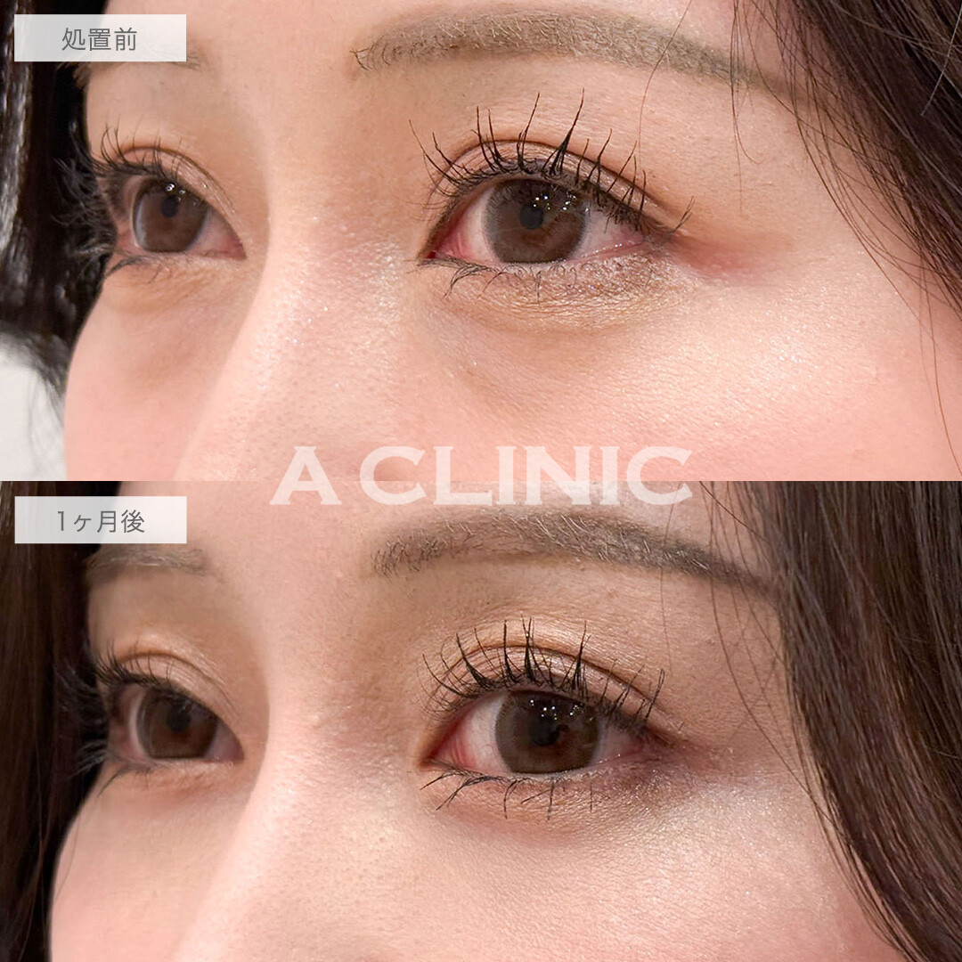 目の下のクマ取りで疲れ目解消し明るい目元へ！こちら処置前と1ヶ月後の症例です(30代女性)