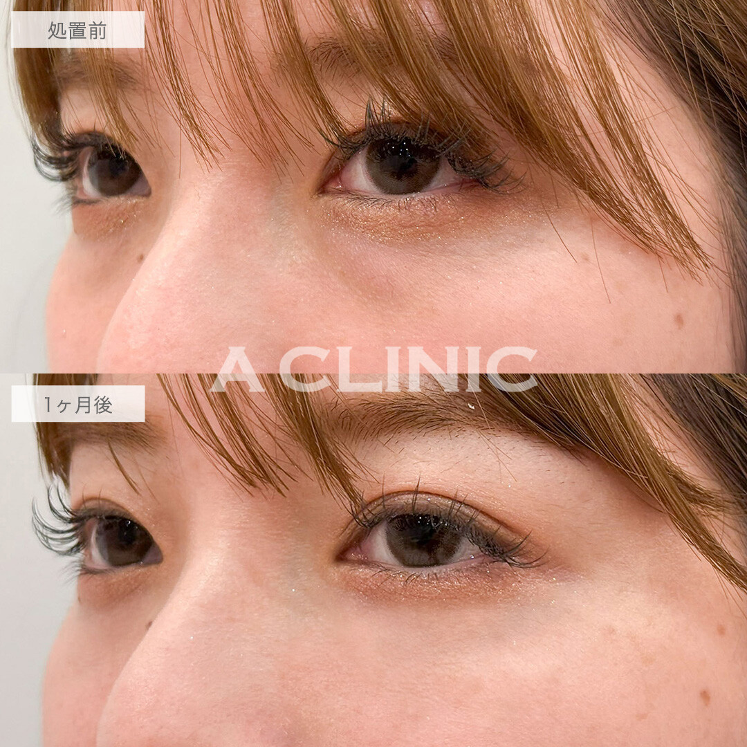 目の下のクマ取りで余分な脂肪を取り除きスッキリとした目元へ！こちら処置前と1ヶ月後の症例です(30代女性)