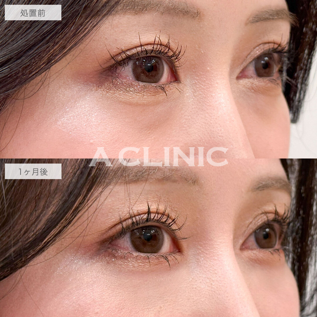 目の下のクマ取りで疲れ目解消し明るい目元へ！こちら処置前と1ヶ月後の症例です(30代女性)