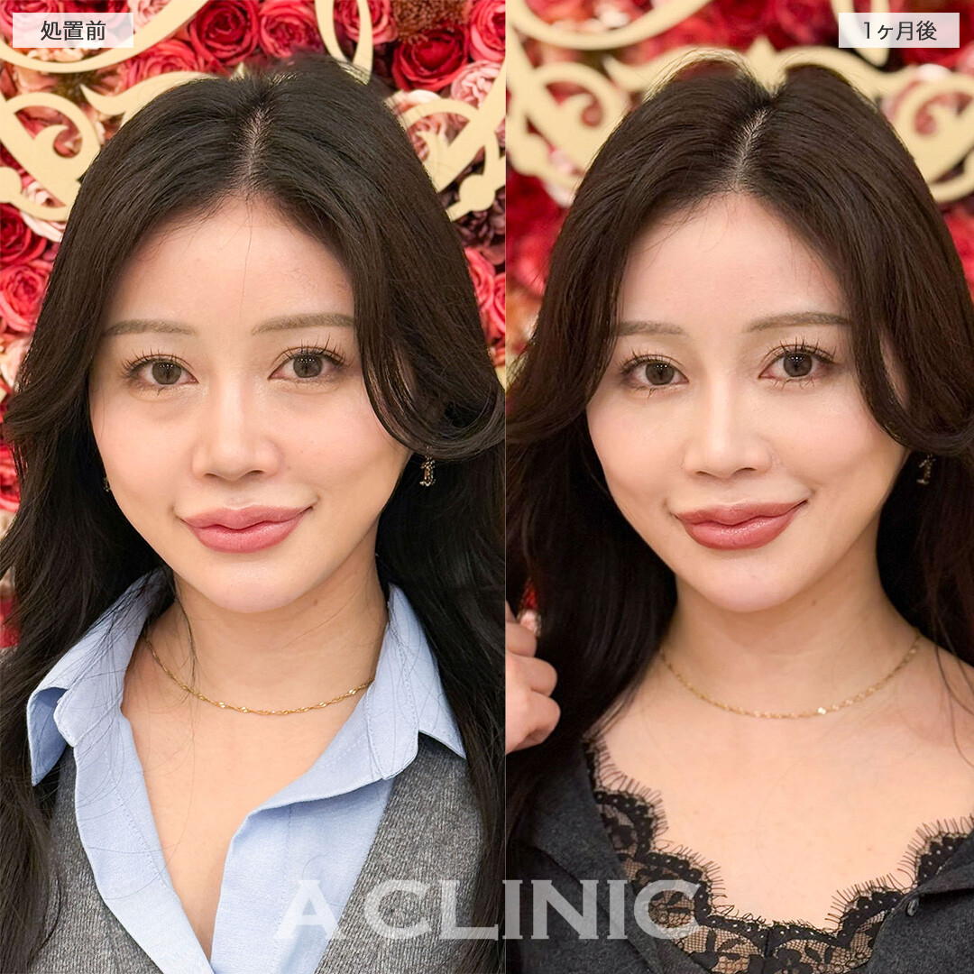 目の下のクマ取りで疲れ目解消し明るい目元へ！こちら処置前と1ヶ月後の症例です(30代女性)