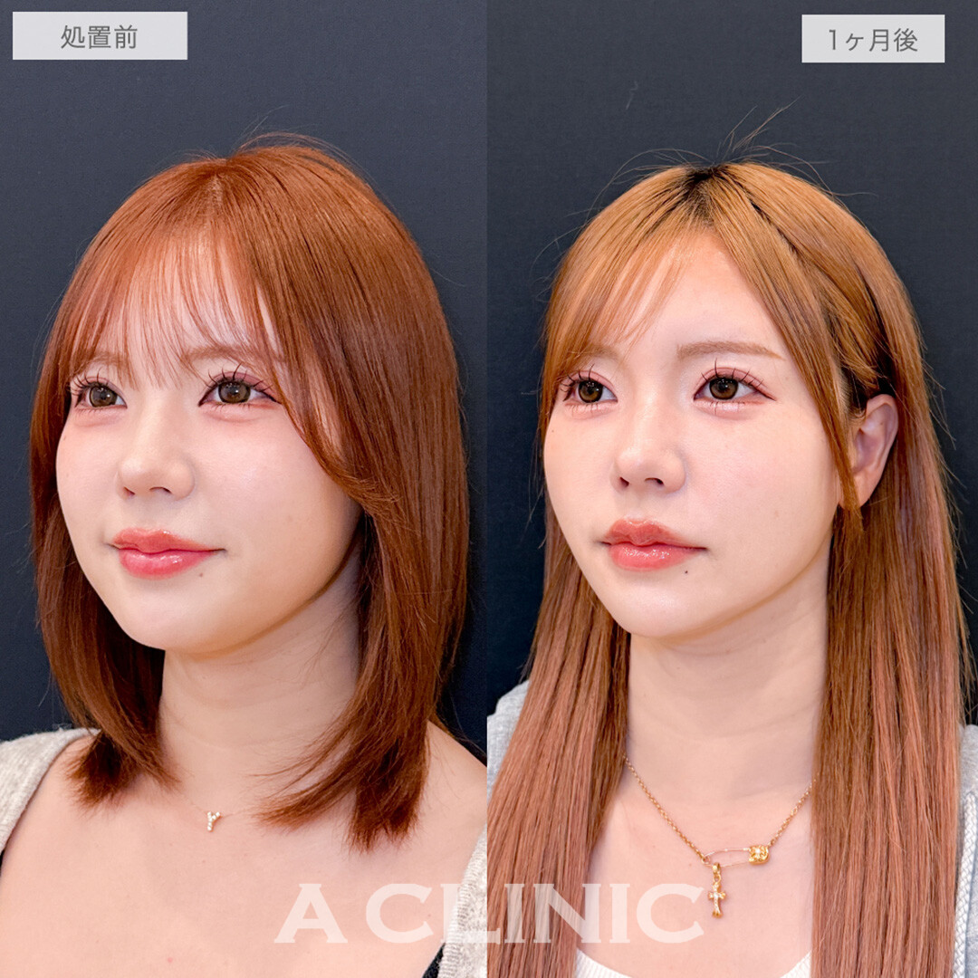 1day小顔脂肪吸引でコンプレックスだった二重あごがスッキリ消えた！処置前と1ヶ月後の症例です(30代女性)