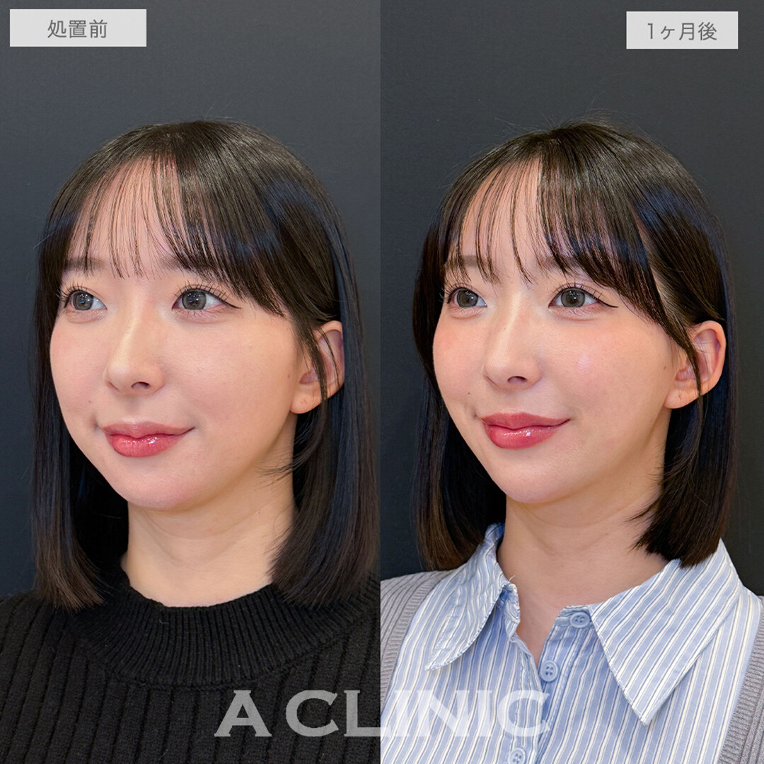 1day小顔脂肪吸引とあごへのヒアルロン酸注入で周りから褒められる唯一無二の小顔に！処置前と1ヶ月後の症例です(20代女性)