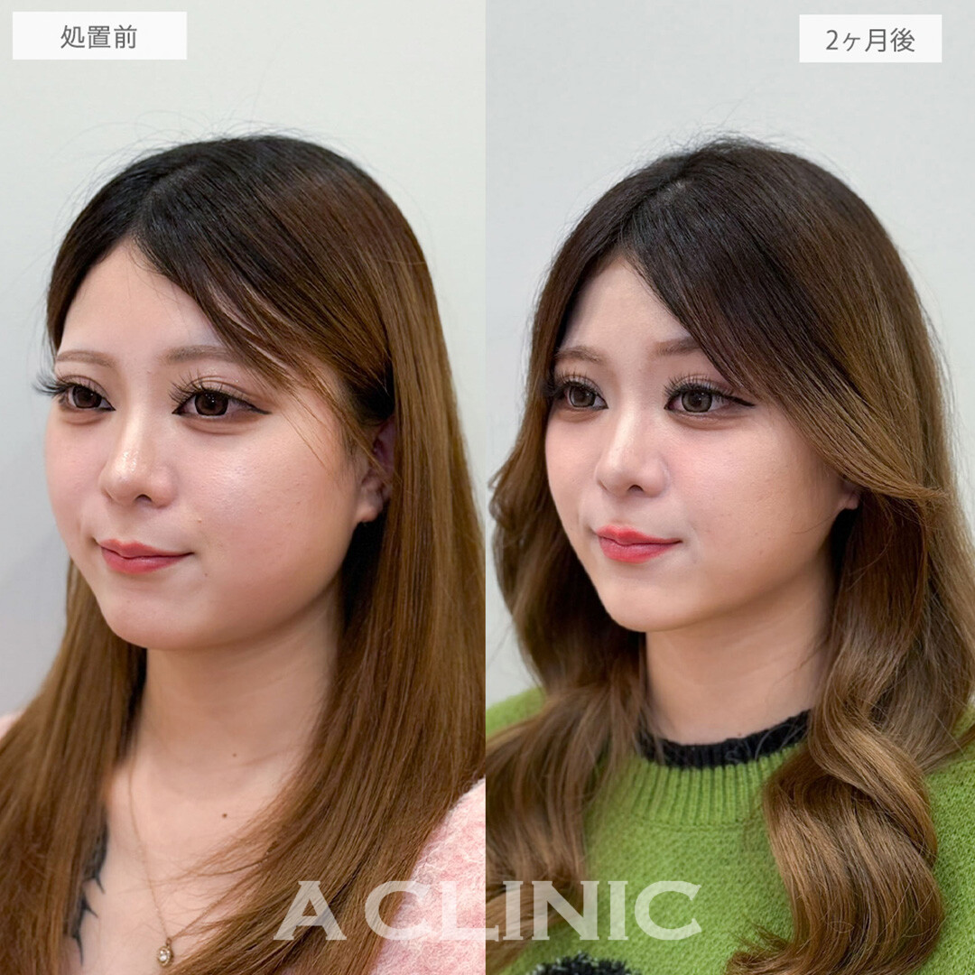 1day小顔脂肪吸引と小顔エラボトックスで首との境目がクッキリシャープになりました！処置前と2ヶ月後の症例です(20代女性)