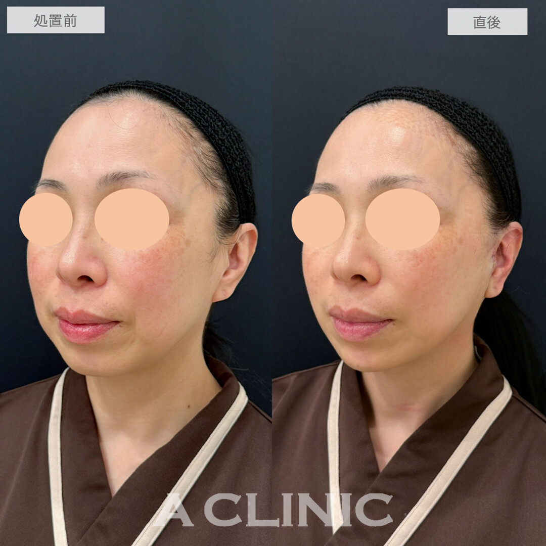 A式美肌たるみ切開とあごへのヒアルロン酸注入でたるみがぐっと引きあがり直後から若返りが可能に！処置前と直後の症例です(40代女性)