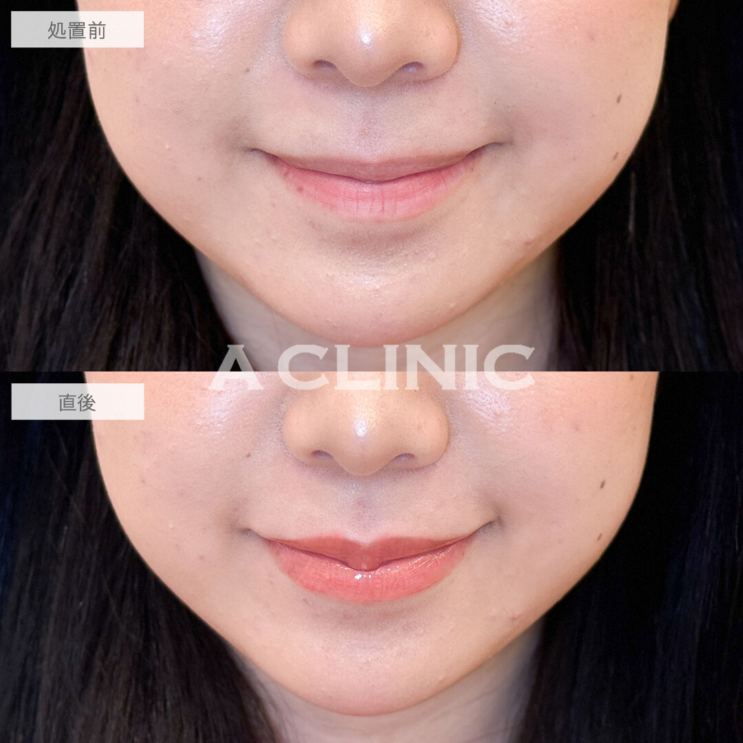 スマイルリップでコンプレックスの薄い唇を解消し多幸感アップ！こちら処置前と直後の症例です(20代女性)