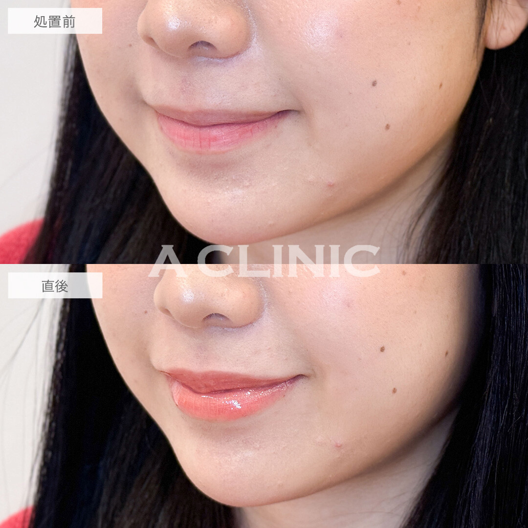 スマイルリップでコンプレックスの薄い唇を解消し多幸感アップ！こちら処置前と直後の症例です(20代女性)