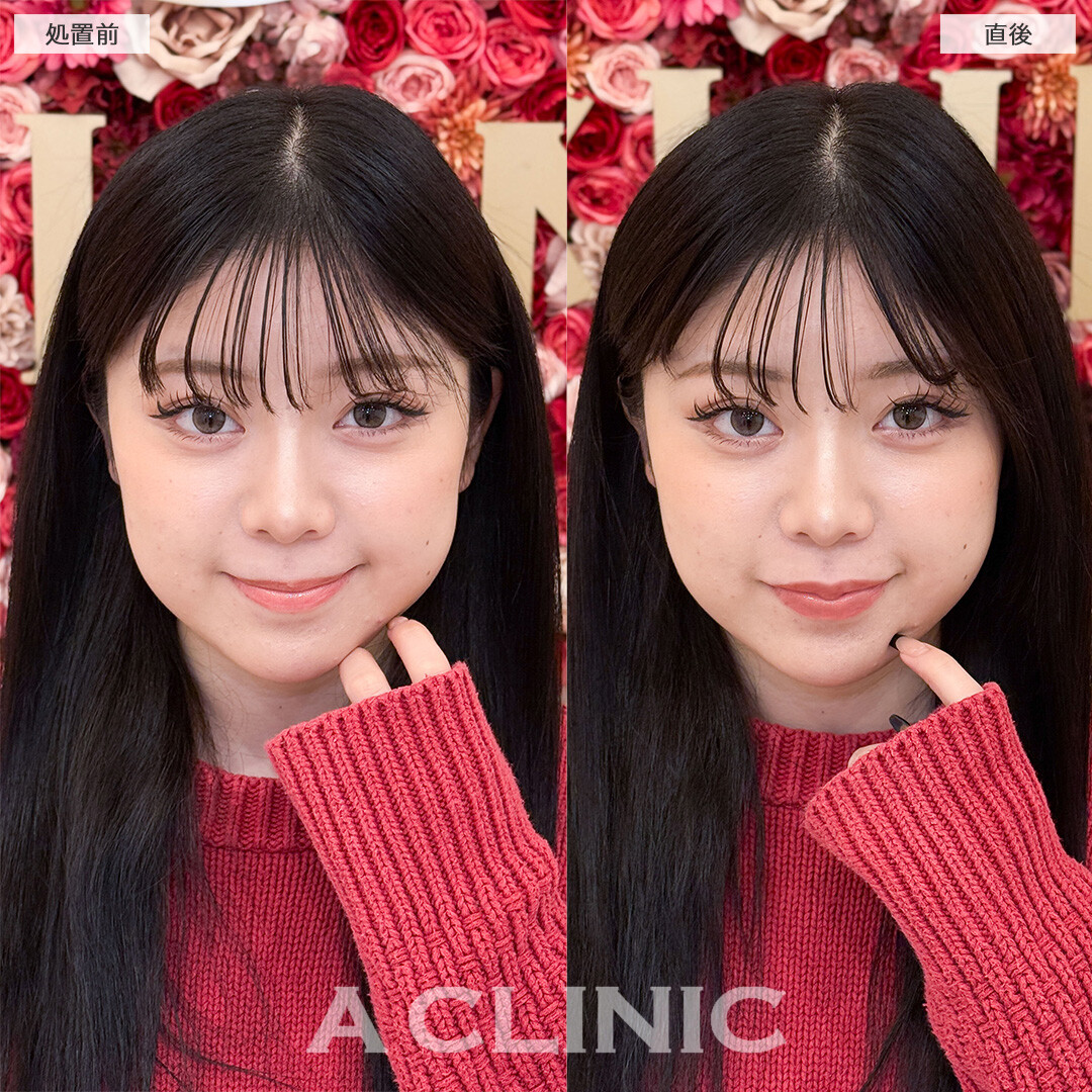 スマイルリップでコンプレックスの薄い唇を解消し多幸感アップ！こちら処置前と直後の症例です(20代女性)