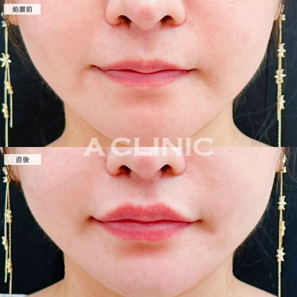 リップヒアルロン酸注入で口元の立体的アップ！処置前と直後の症例です(30代女性)