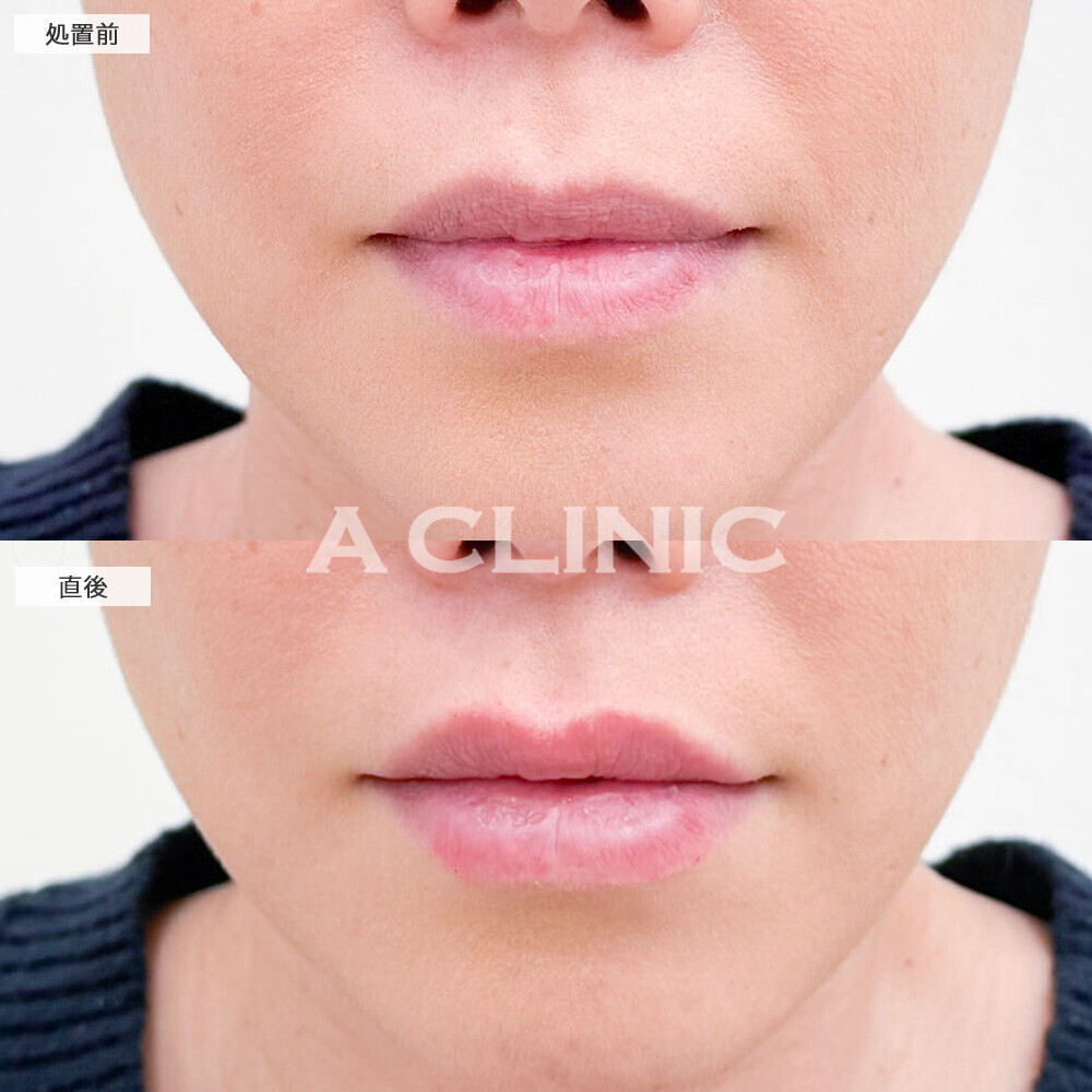 リップヒアルロン酸注入でどこから見ても立体的なリップになりました！こちら処置前と直後の症例です(30代女性)