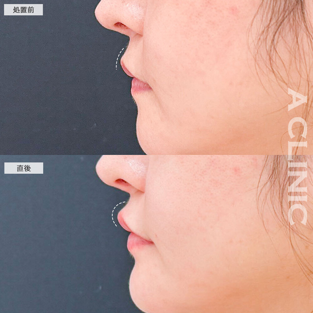 リップヒアルロン酸注入で口元の立体的アップ！処置前と直後の症例です(30代女性)