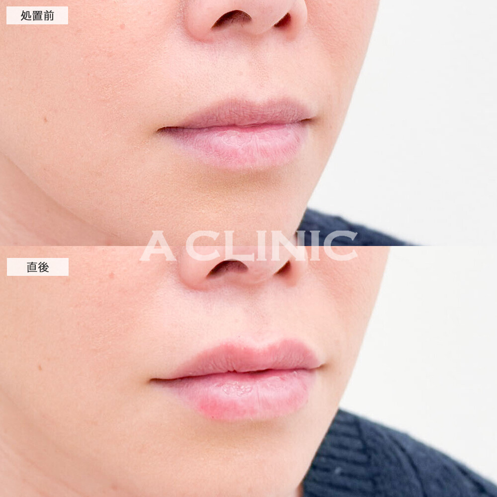 リップヒアルロン酸注入でどこから見ても立体的なリップになりました！こちら処置前と直後の症例です(30代女性)