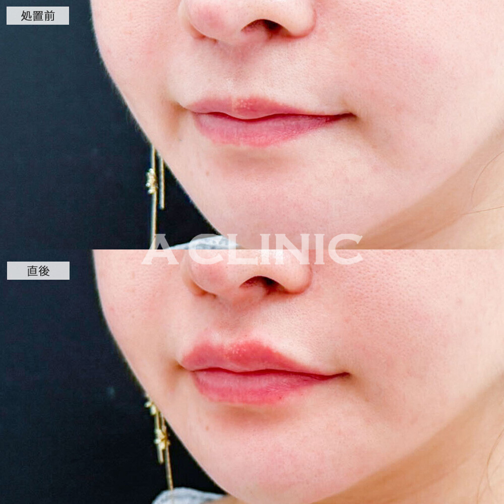 リップヒアルロン酸注入で口元の立体的アップ！処置前と直後の症例です(30代女性)