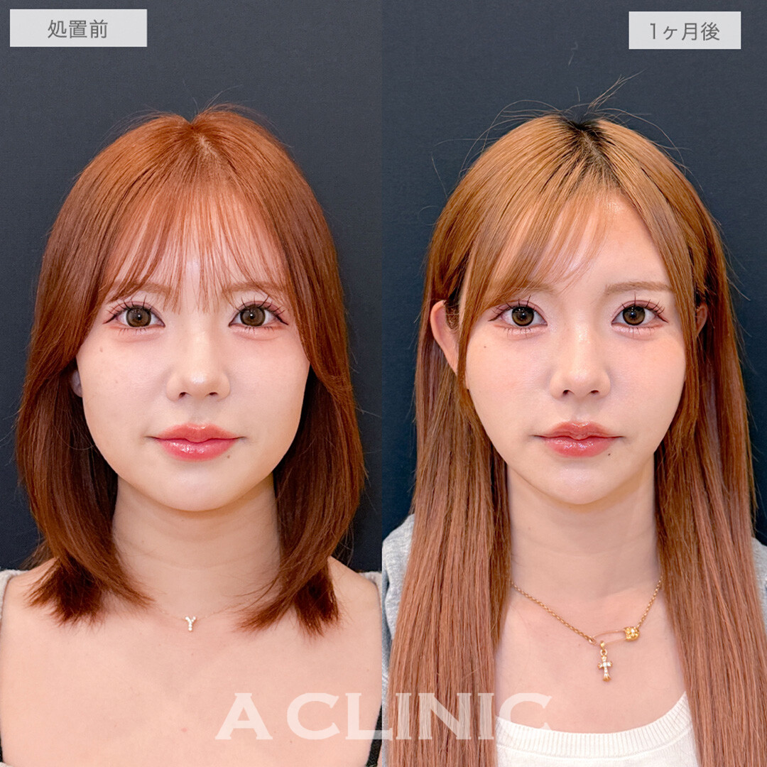 1day小顔脂肪吸引でコンプレックスだった二重あごがスッキリ消えた！処置前と1ヶ月後の症例です(30代女性)