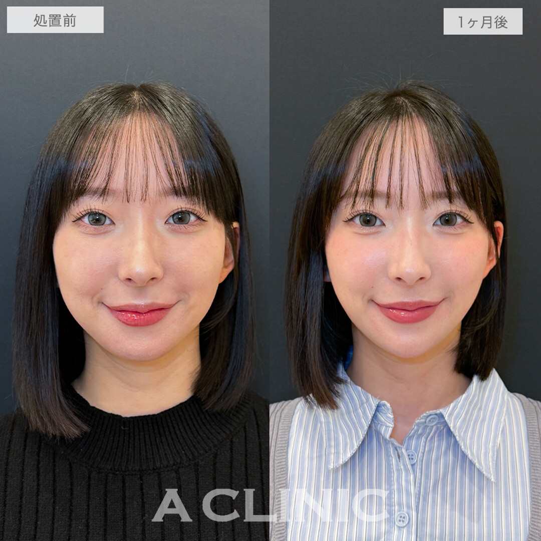 1day小顔脂肪吸引とあごへのヒアルロン酸注入で周りから褒められる唯一無二の小顔に！処置前と1ヶ月後の症例です(20代女性)