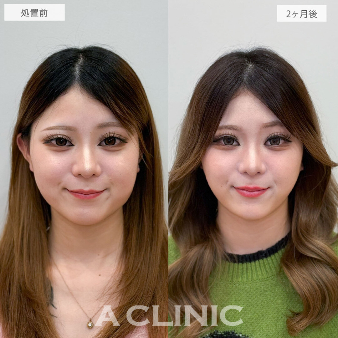 1day小顔脂肪吸引と小顔エラボトックスで首との境目がクッキリシャープになりました！処置前と2ヶ月後の症例です(20代女性)