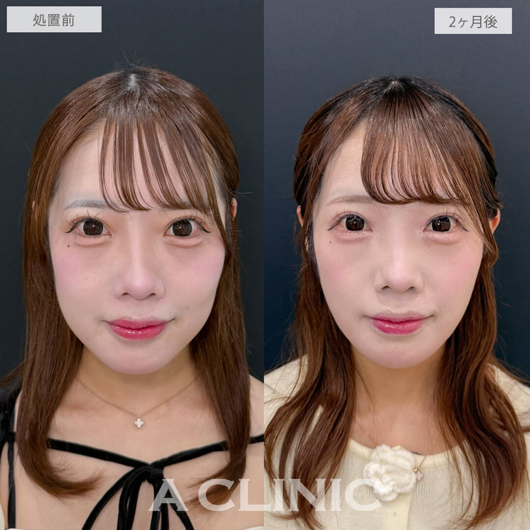 1day小顔脂肪吸引とバッカルファット除去術で小顔と将来的なたるみ予防が同時に叶います！処置前と2ヶ月後の症例です(20代女性)