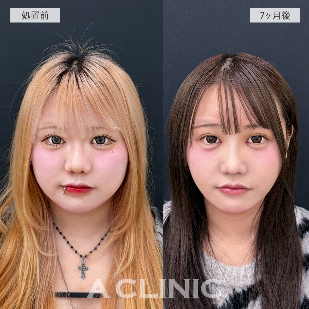 1day小顔脂肪吸引で別人級の小顔に大変身！処置前と7ヶ月後の症例です(10代女性)