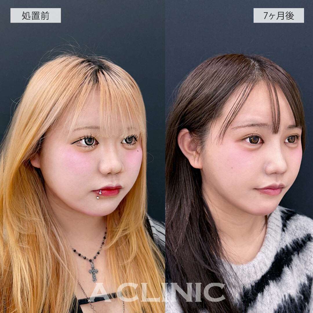 1day小顔脂肪吸引で別人級の小顔に大変身！処置前と7ヶ月後の症例です(10代女性)